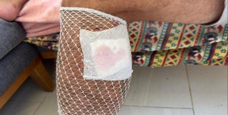 Yürüyüş yaparken başıboş sokak köpeklerinin saldırısına uğradı